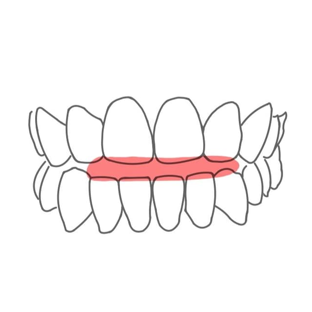 Offener Biss:
beim Kieferschluss bleibt zwischen Ober- und Unterkiefer ein Spalt offen (meistens in der Front).