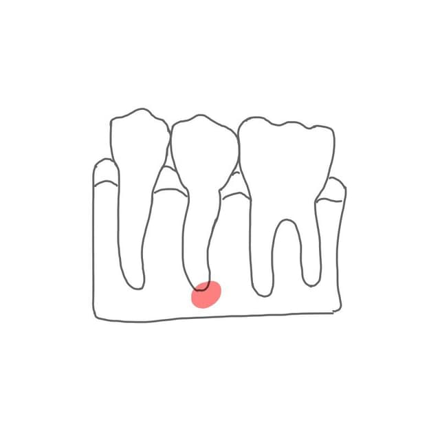 Radikuläre Zyste: 
die Zyste entsteht im Bereich der Wurzel (Radix = Wurzel).