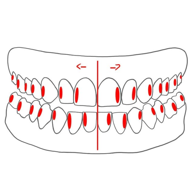 distal (d) = von der Zahnbogenmitte weg
- alle Zähne / Kiefer