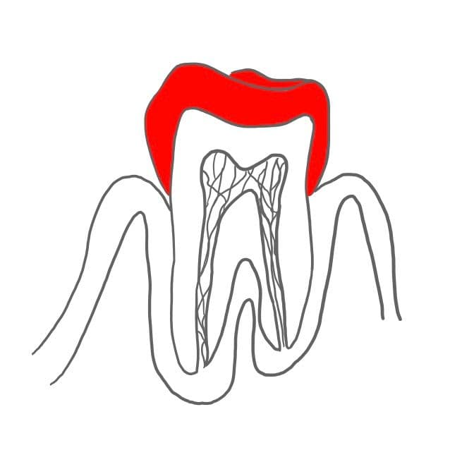 Zahnschmelz (Enamelum):