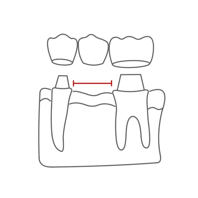 Die Lücke, also der Abstand von Pfeilerzahn zu Pfeilerzahn, wird als Spanne bezeichnet.