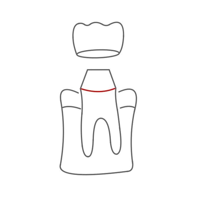 oder supragingival (über dem Zahnfleisch) liegen.