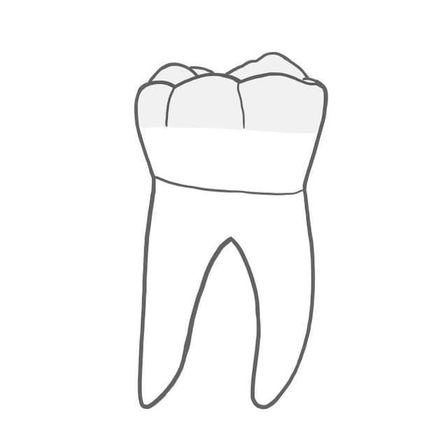 Overlay / Teilkrone:
bedeckt die gesamte Kaufläche, also auch alle Höcker.