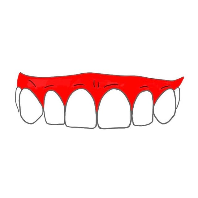 Zahnfleisch (Gingiva):