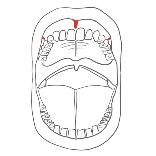 Lippenbändchen = frenulum labii
Wangenbändchen = frenulum buccale