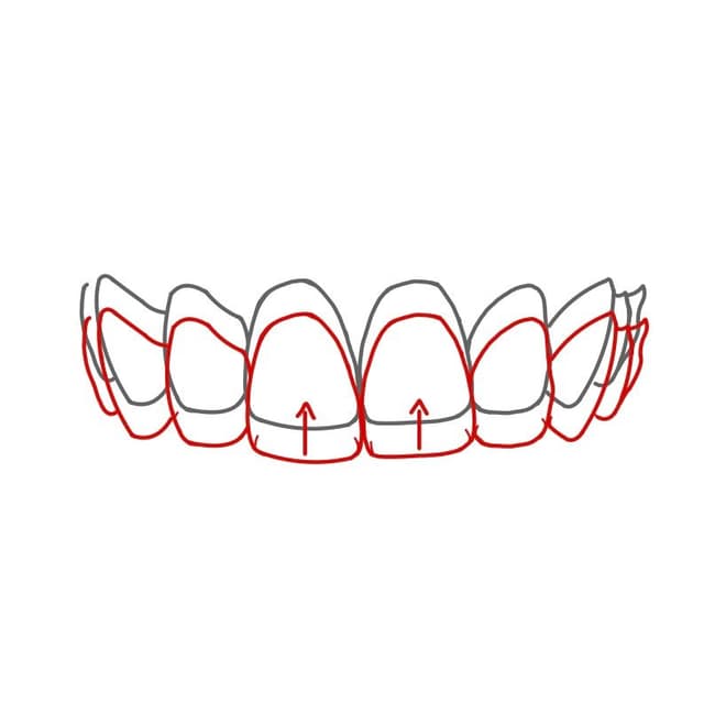 Kunststoffschienen (z.B. Invisalign):