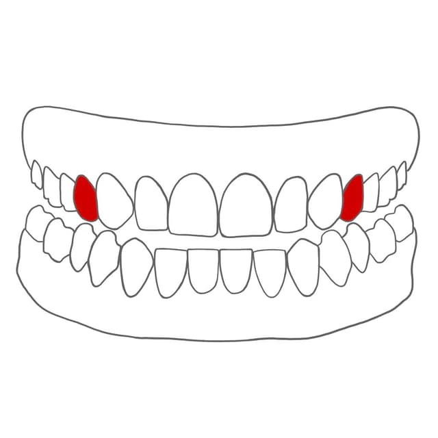 2 Wurzelkanäle:
14,
24