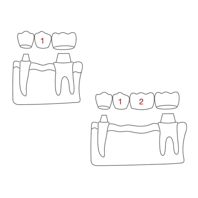 Gibt es nur eine Lücke, wird sie als einspannig bezeichnet (egal wie viele Zähne ersetzt werden).
Brücken mit mehreren Lücken heißen mehrspannig.