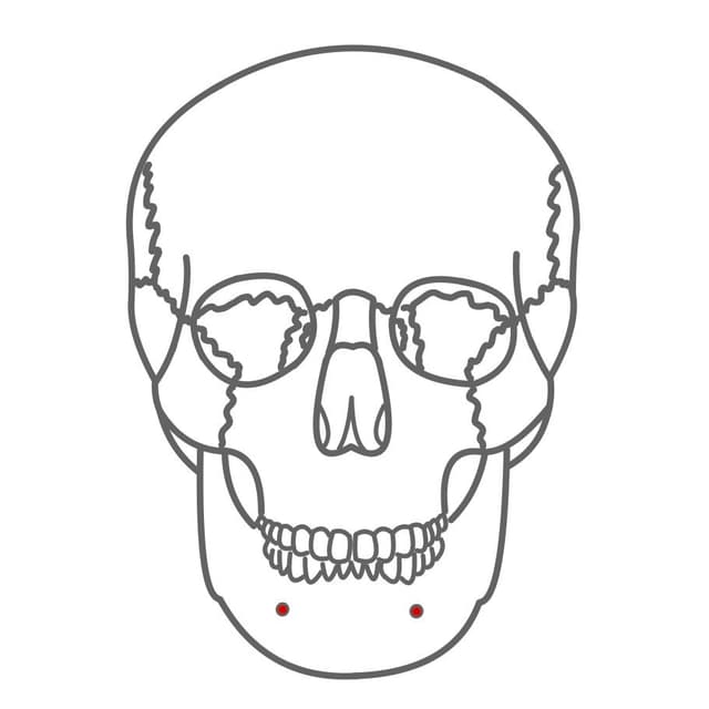 Foramen mentale:
um die Unterkiefer Frontzähne zu betäuben.