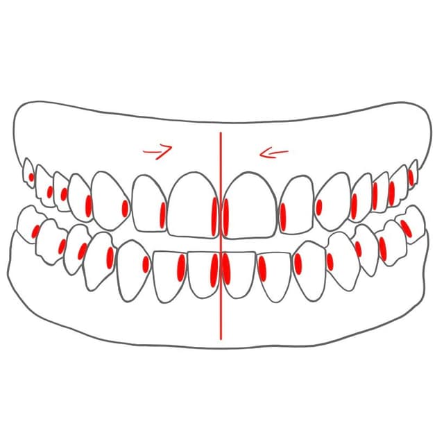 mesial (m) = zur Zahnbogenmitte hin
- alle Zähne / Kiefer