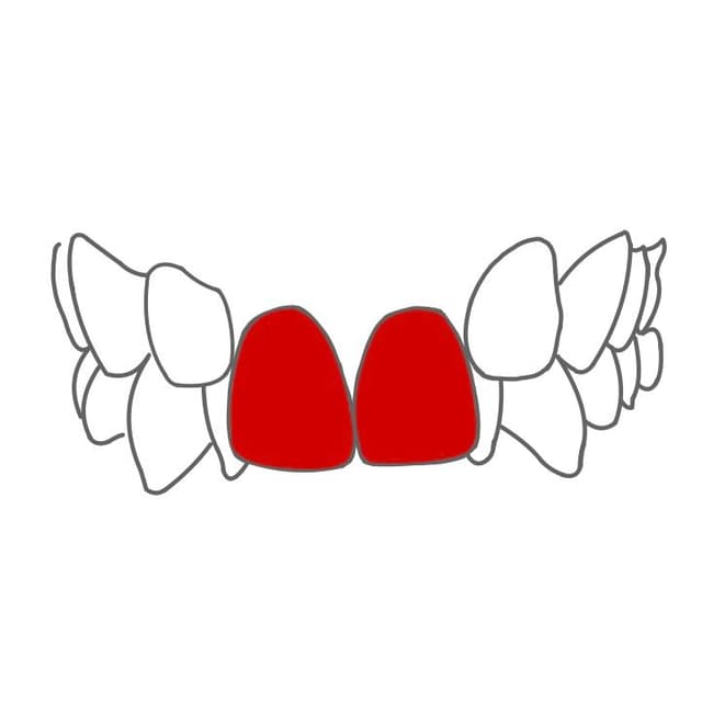 Deckbiss:
ein tiefer Biss tritt gleichzeitig mit einer retrudierten Front auf.