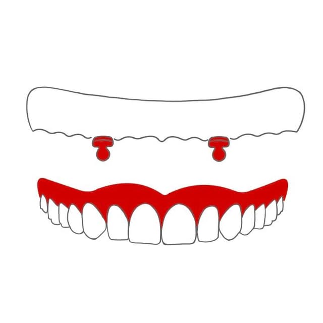 Knopfanker:
bei wurzelkanalbehandelten Zähnen wird ein Stift eingesetzt, welcher am oberen Ende eine Kugel hat.