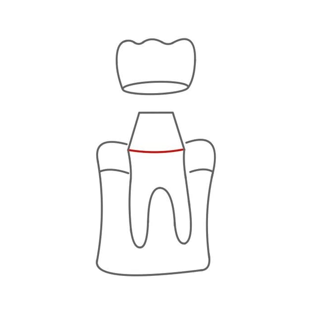 Dieser kann entweder subgingival (unter dem Zahnfleisch)