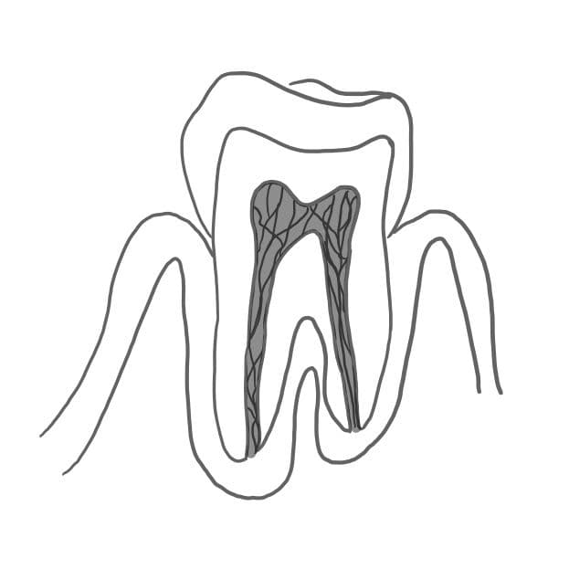 Pulpagangrän: 
das abgestorbene Gewebe wird von Bakterien zersetzt und faulig riechende Gase entstehen.