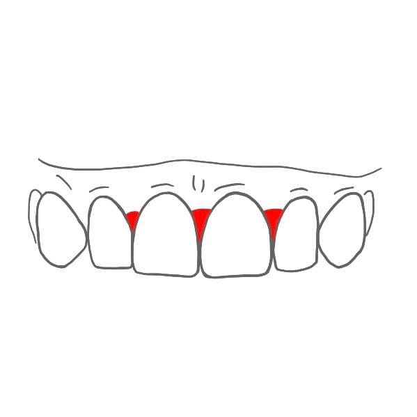 Die Zwischenräume sind mit sogenannten Interdentalpapillen ausgefüllt.
Sie schauen aus wie kleine Dreiecke zwischen den Zähnen.