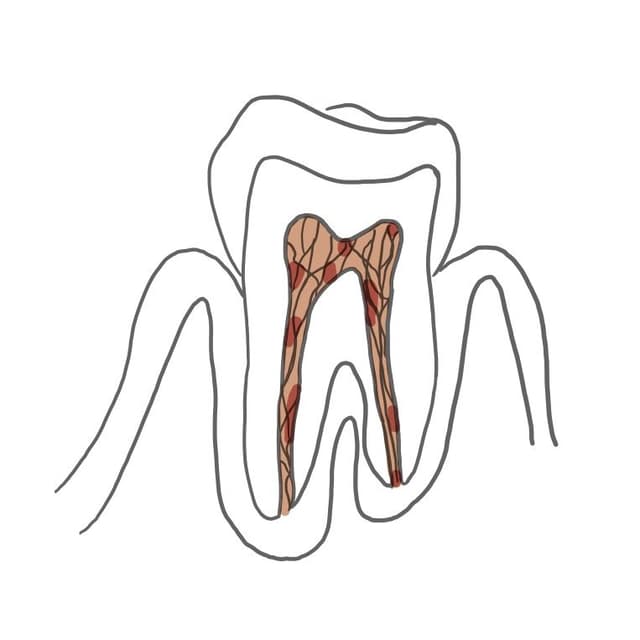 Pulpanekrose: 
das Gewebe stirbt erst stellenweise und später vollständig ab.