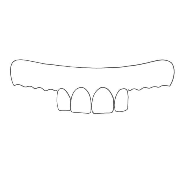 Bei der Alveolotomie wird der Alveolarknochen nach einer Extraktion von mehreren Zähnen geglättet.