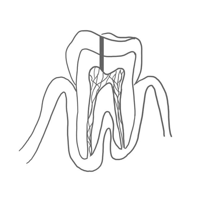 Der Stift ist parapulpär, er berührt die Pulpa also nicht.
